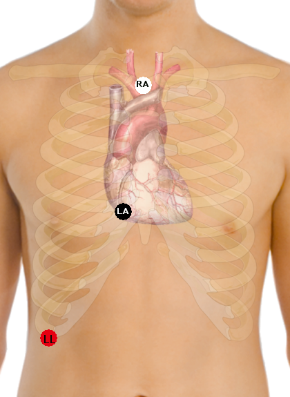 Electrode placement for Lewis lead; RL electrode (green), not shown, remains on leg Lewis lead placement EKG.png