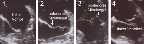 File:Mitralinsuff TEE leg.jpg