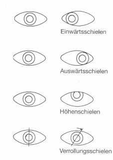 Schematische Darstellung verschiedener Schielformen