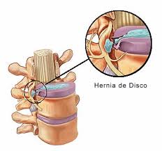 A e B. Ressonância magnética (T1) evidenciando hérnia discal