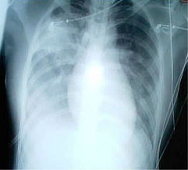 Une radiographie pulmonaire montrant des opacités dans les deux poumons, indicatives d'une pneumonie, chez un patient atteint de SRAS.
