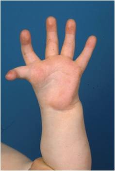 Hypoplasia of the thumb of type 3B