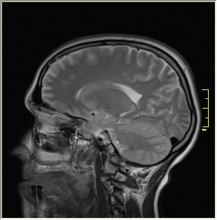 File:Brain MRI glioma 090.jpg