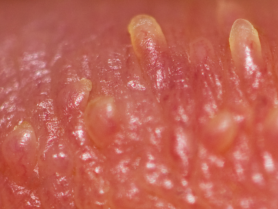 Pearly penile papules 004 2.jpg. 