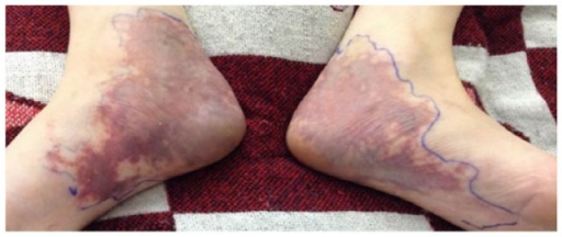 Redness and swelling in a foot caused by livedoid dermatitis