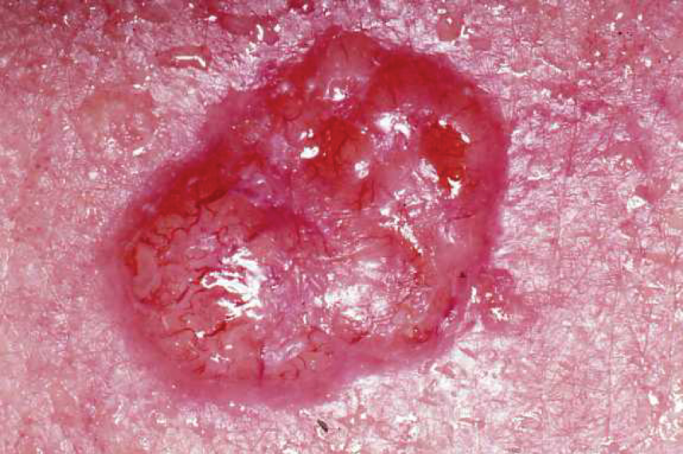Image result for basal cell carcinoma