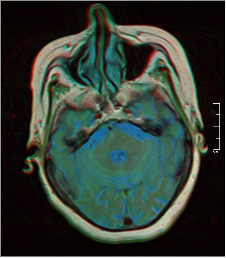 File:Brain MRI 0052 14.jpg