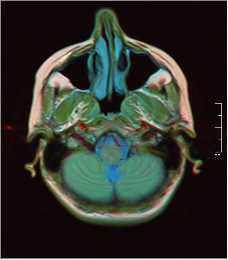 File:Brain MRI 0146 18.jpg