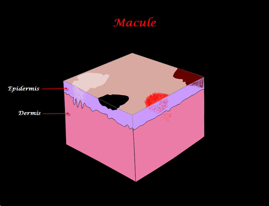 Macule | definition of macule by Medical dictionary