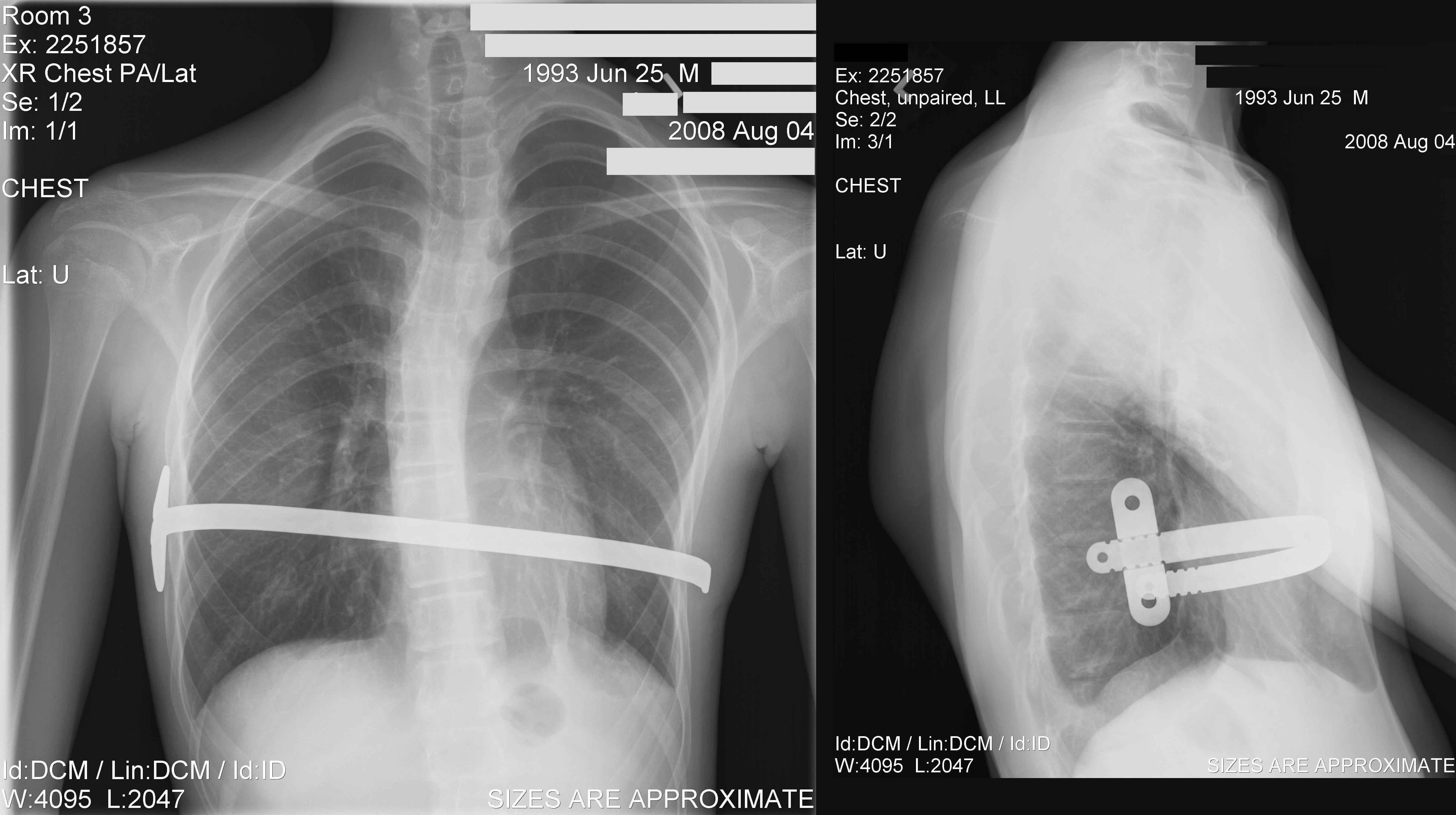 Chest radiography after the Nuss procedure. Four types of bar