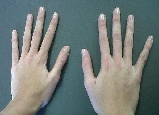 Marfan syndrome hallmarks: claw-shaped hand with long fingers (a