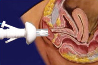 File:Dilating vaginal speculum.jpg