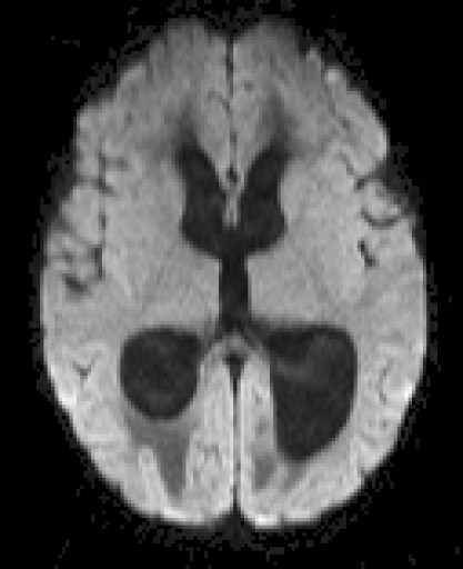 File:Medulloblastom - MRT - axial DWI - 018.jpg