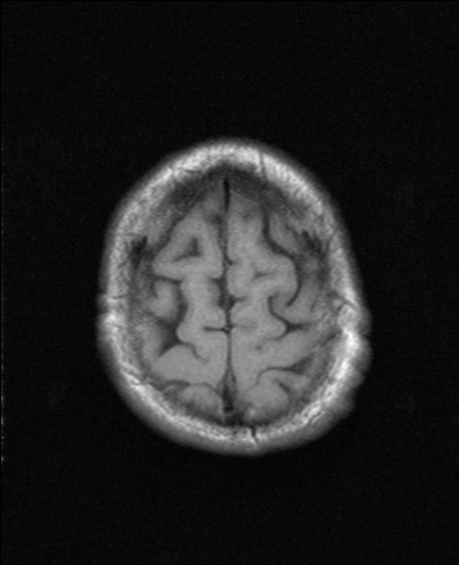 File:NPH MRI 082.png