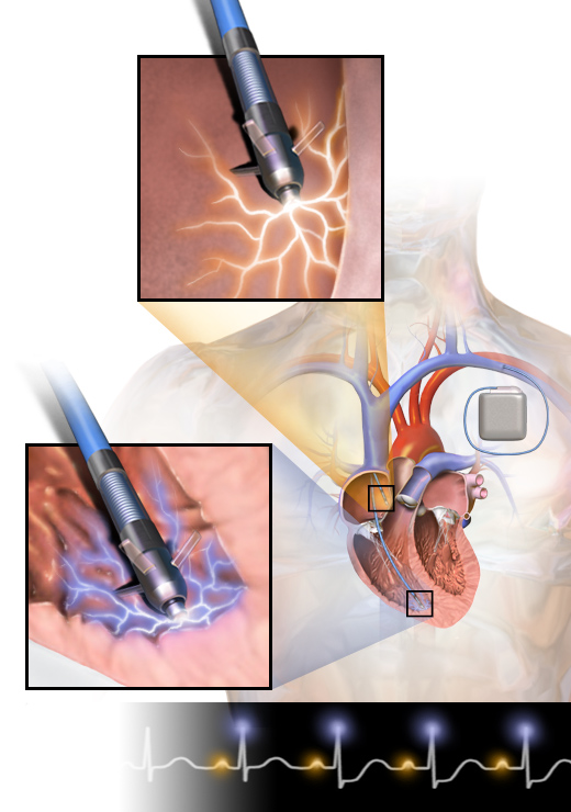 https://upload.wikimedia.org/wikipedia/commons/d/d5/Pacemaker.png