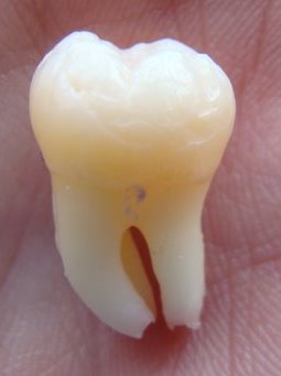 File:Unerupted not fully formed wisdom tooth.jpg