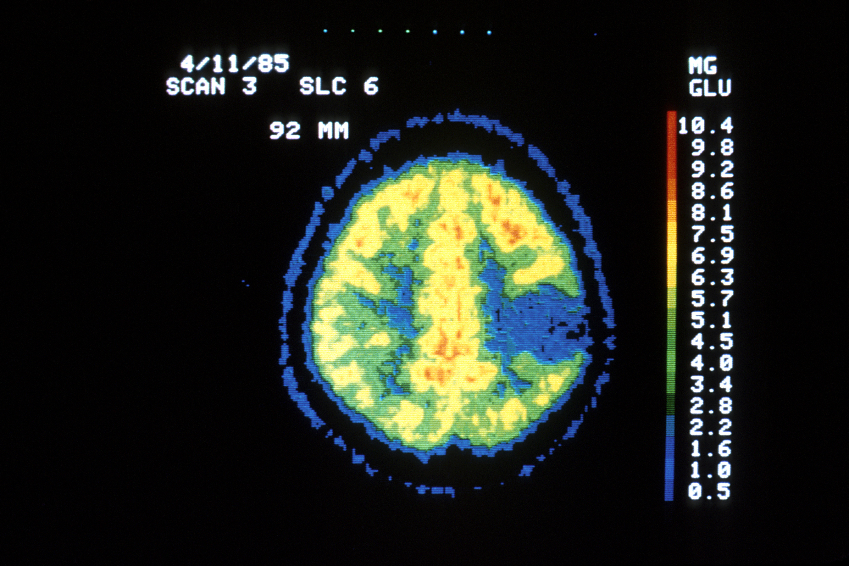 brain pet scan epilepsy