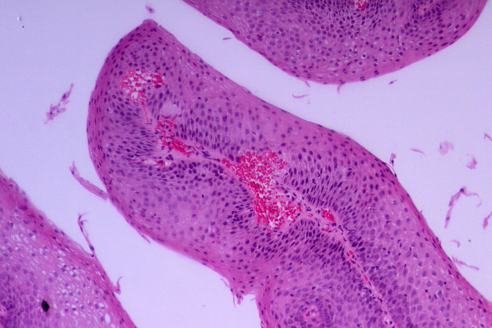 Esophageal papillomatosis pathology, neoplasia 1 squamous papilloma cancer malign la picior