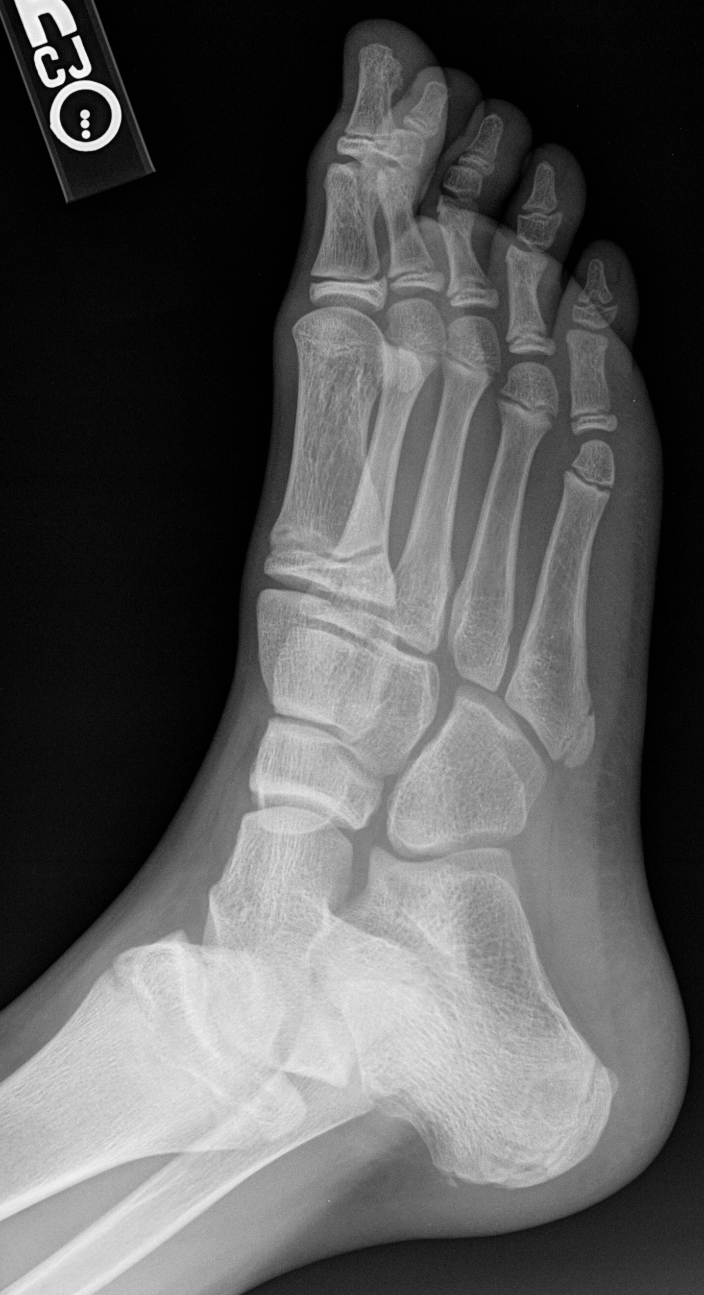 https://upload.wikimedia.org/wikipedia/commons/d/d6/X-ray_of_a_normal_foot_of_a_12_year_old_male_-_oblique.jpg