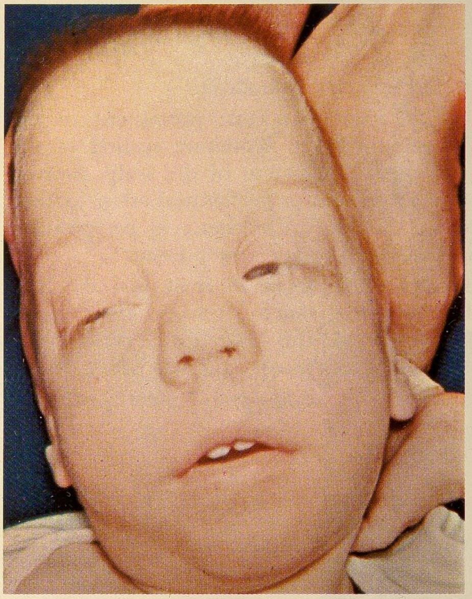 Smith–Lemli–Opitz syndrome - Wikipedia