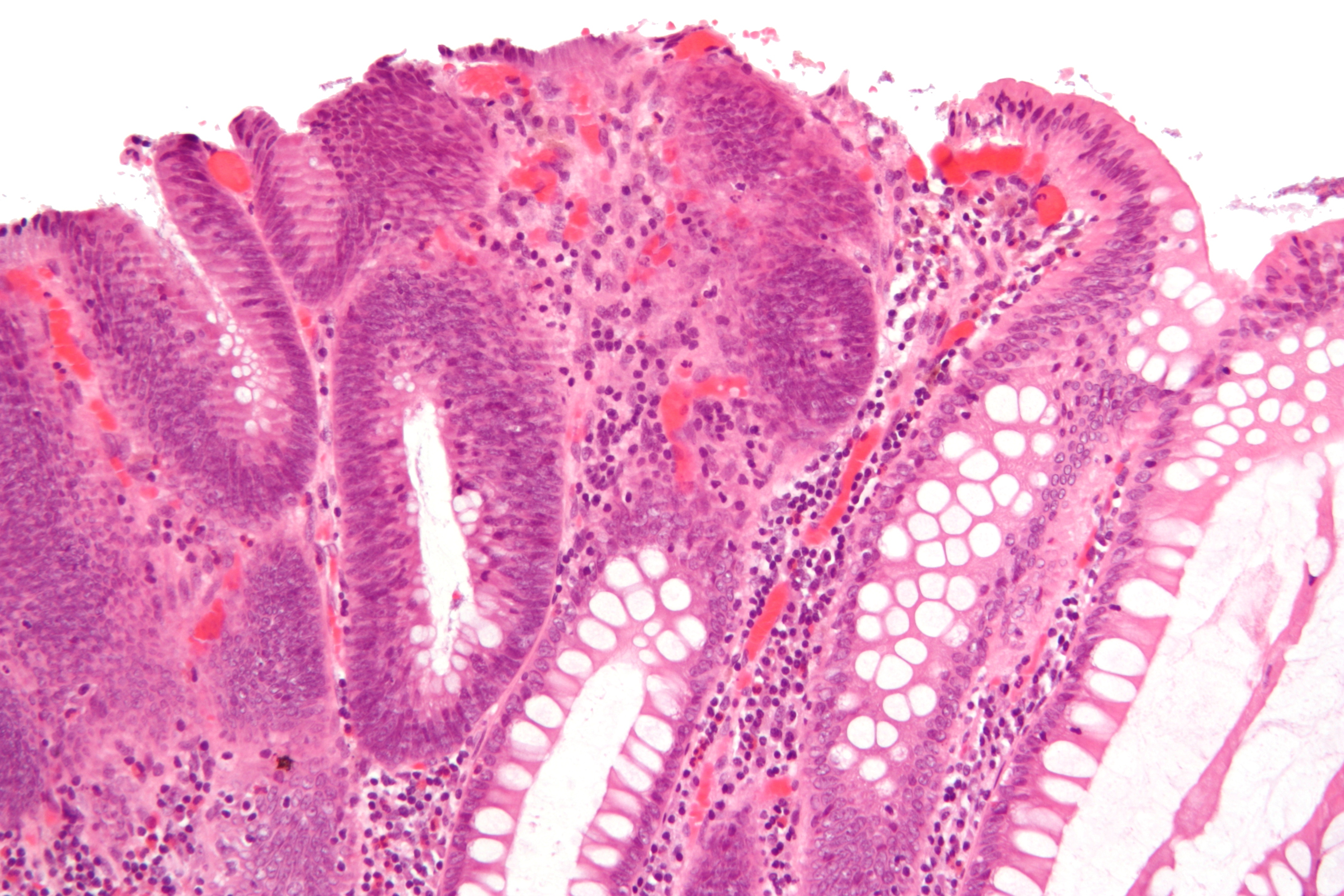 tubulovillous adenoma with dysplasia