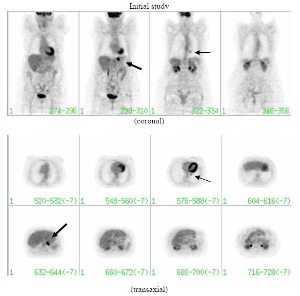 File:FDG-PET initial study solitary pulmonary nodule Non-Hodgkin lymphoma.jpg