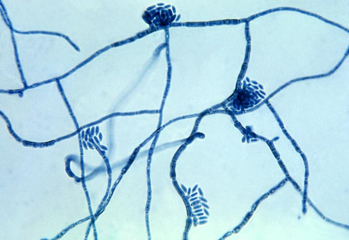 A. Extensive tinea nigra palmaris (case 1; Table 1); B. Localized