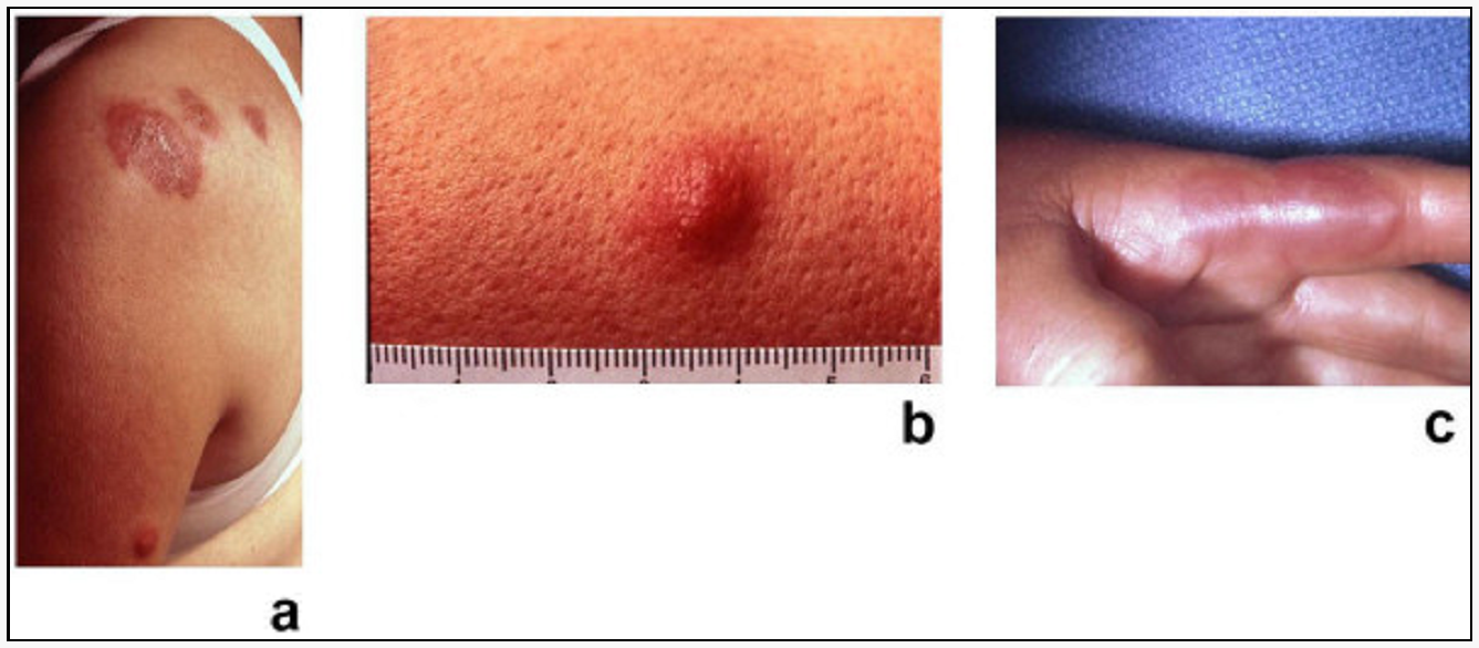 Rashes on the feet - RightDiagnosis.com