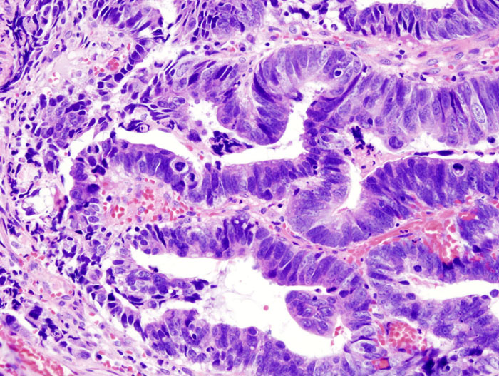 File:Colonic adenocarcinoma (1) Endoscopic biosy.jpg