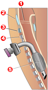 Схема трахеостомической трубки в трахее