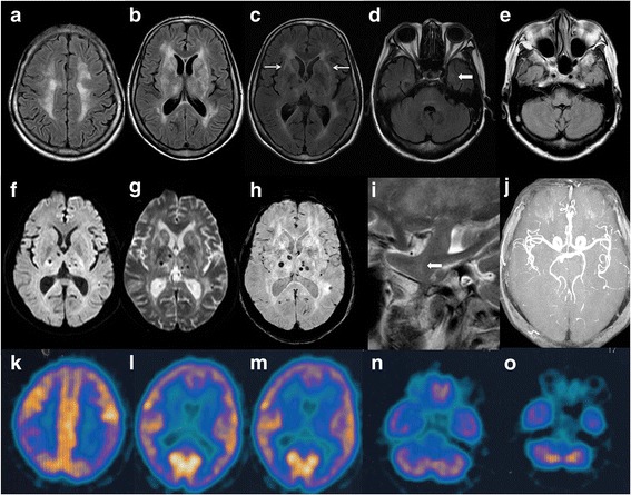 File:Cranial imaging of a FFI patient.jpg