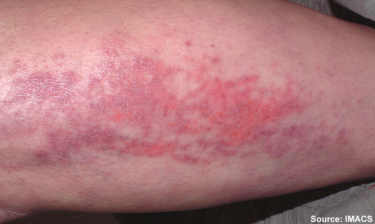 Slide show: Common skin rashes - Mayo Clinic