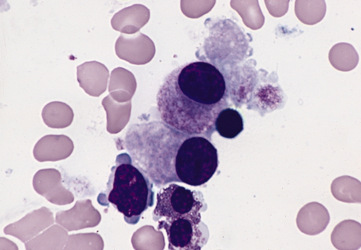 File:Megakaryocytes in MDS (RAEB and 5q-chromosome abnormality).jpg