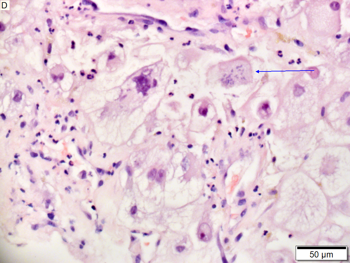 Metastasis of renal cell carcinoma to liver