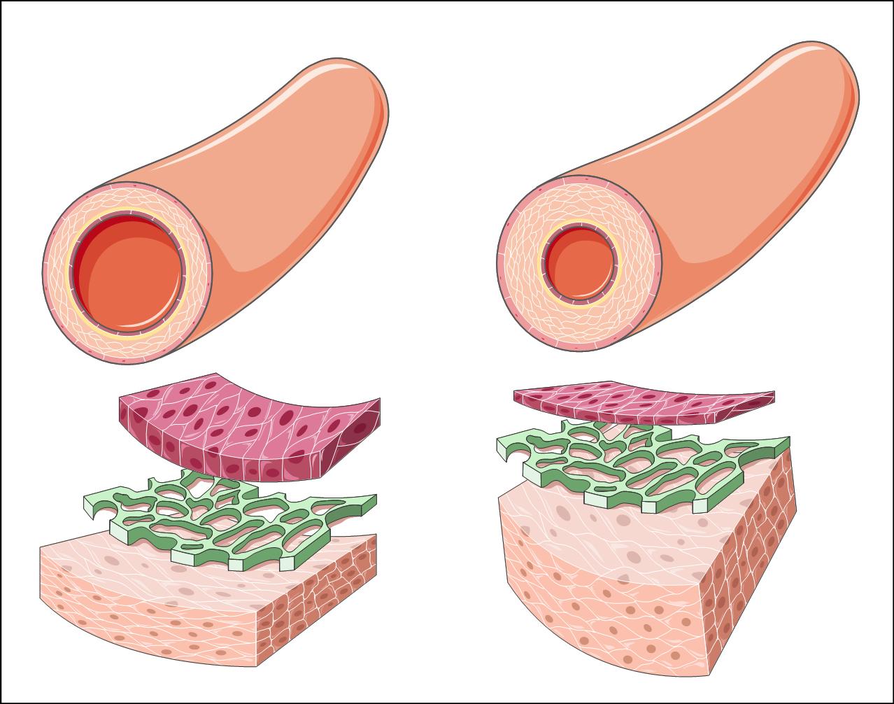 Medición de la circunferencia abdominal: MedlinePlus enciclopedia médica  illustración