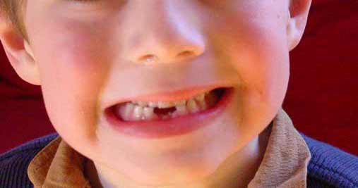 Image result for child missing front teeth