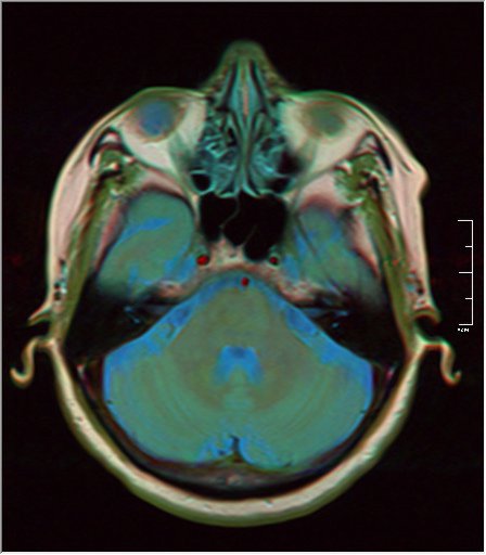 File:Brain MRI 0213 15.jpg