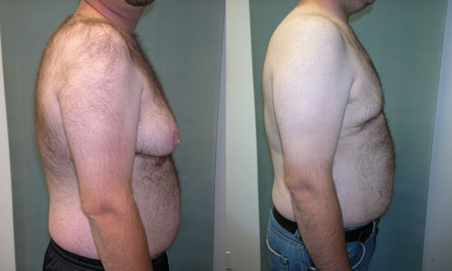 File:Severe Gynecomastia.jpg