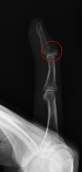 Zlomenina avulze xray finger.jpg