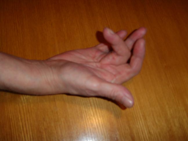 Dupuytren's contracture - Wikipedia