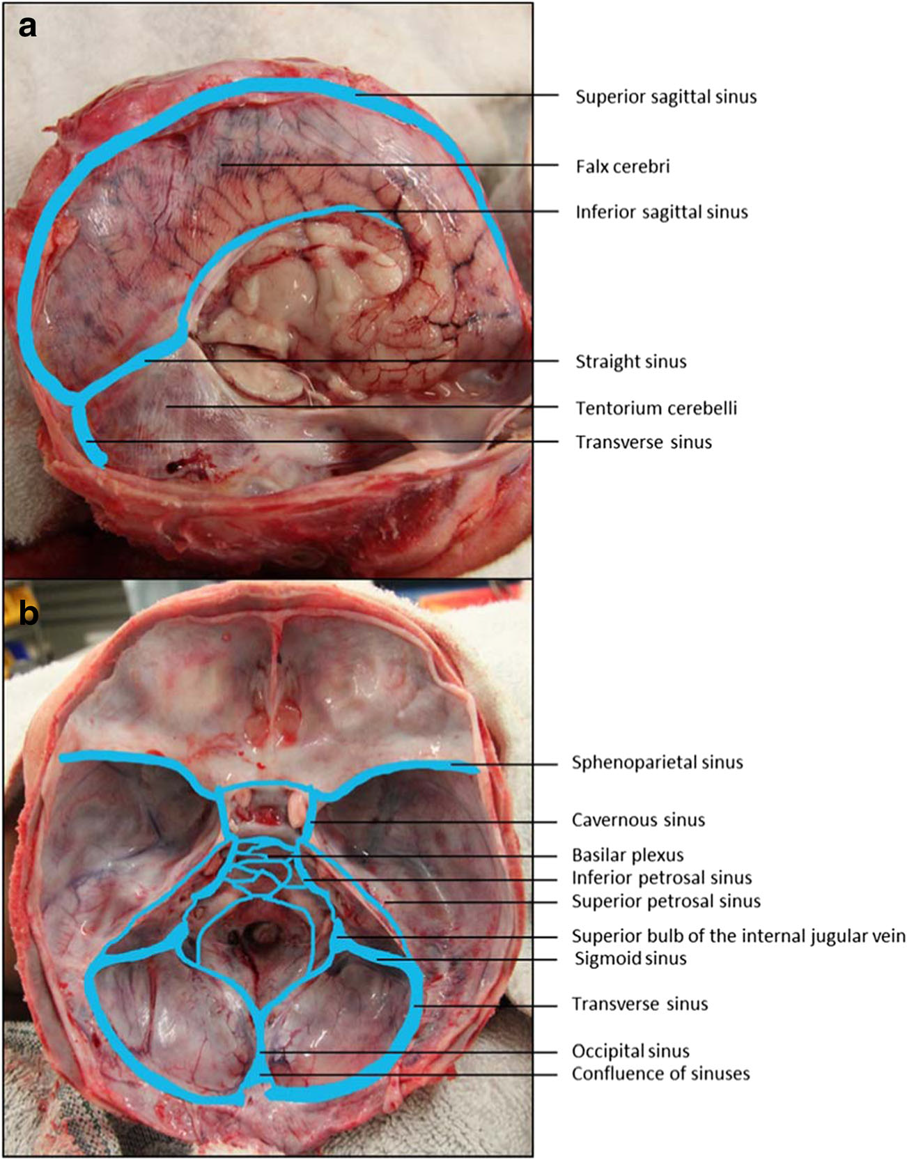 confluence of sinuses