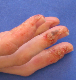 File:DyshidroticDermatitisOnHandsLateStage.jpg