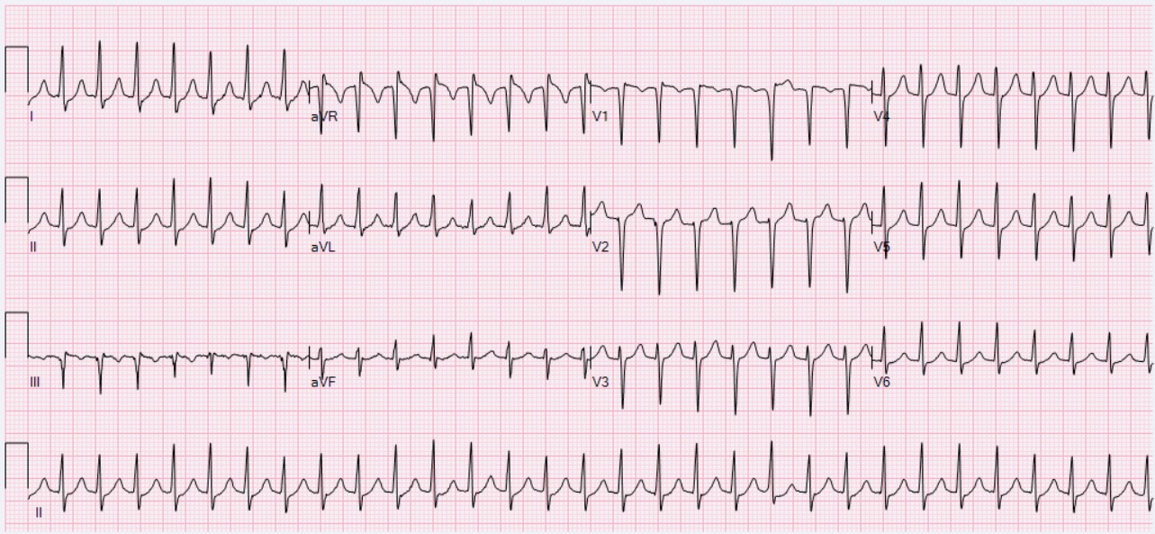 Electrocardiography - Wikipedia