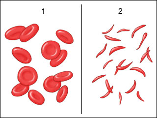 Sickle cell anemia.jpg