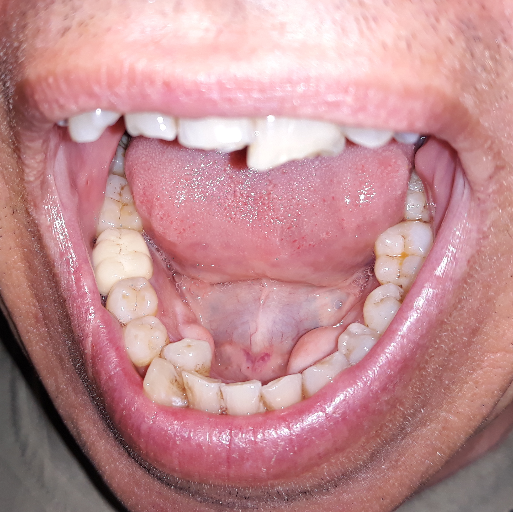 過剰歯 Wikipedia