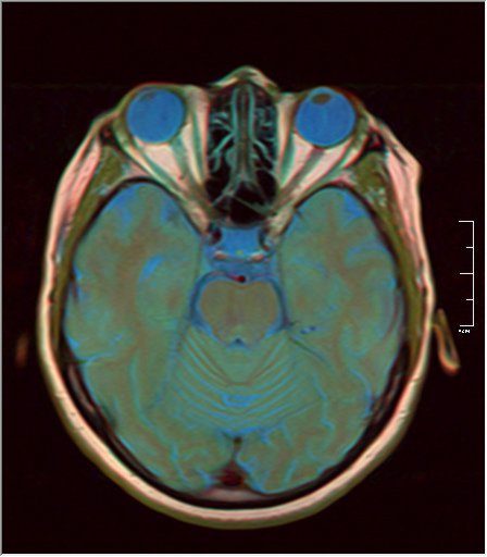 File:Brain MRI 0213 13.jpg