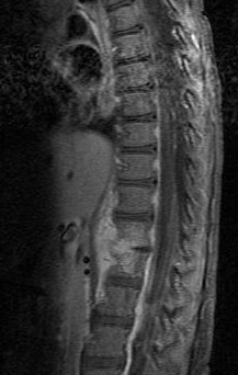 Дисцит з паравертебральним абсцесом у дворічної дитини, сагітальне МРТ-зображення