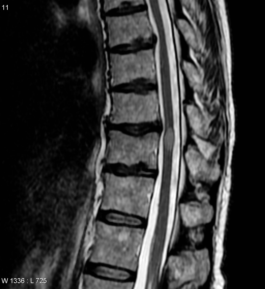 Transverse Myelitis Wikipedia