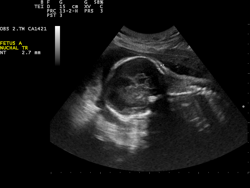 File:Ultrasound Scan ND 0120095833 1003180.png