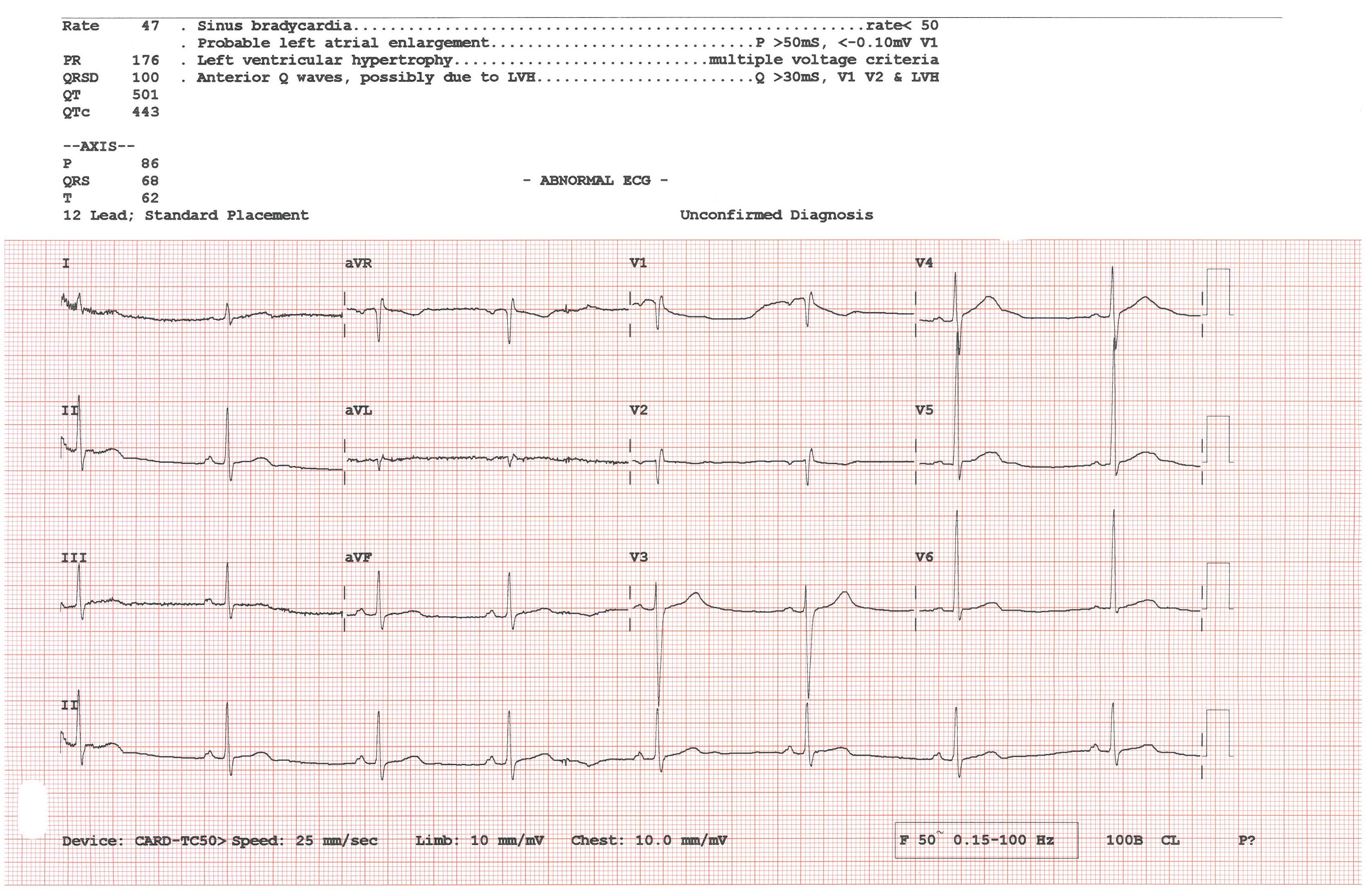 Electrocardiography - Wikipedia